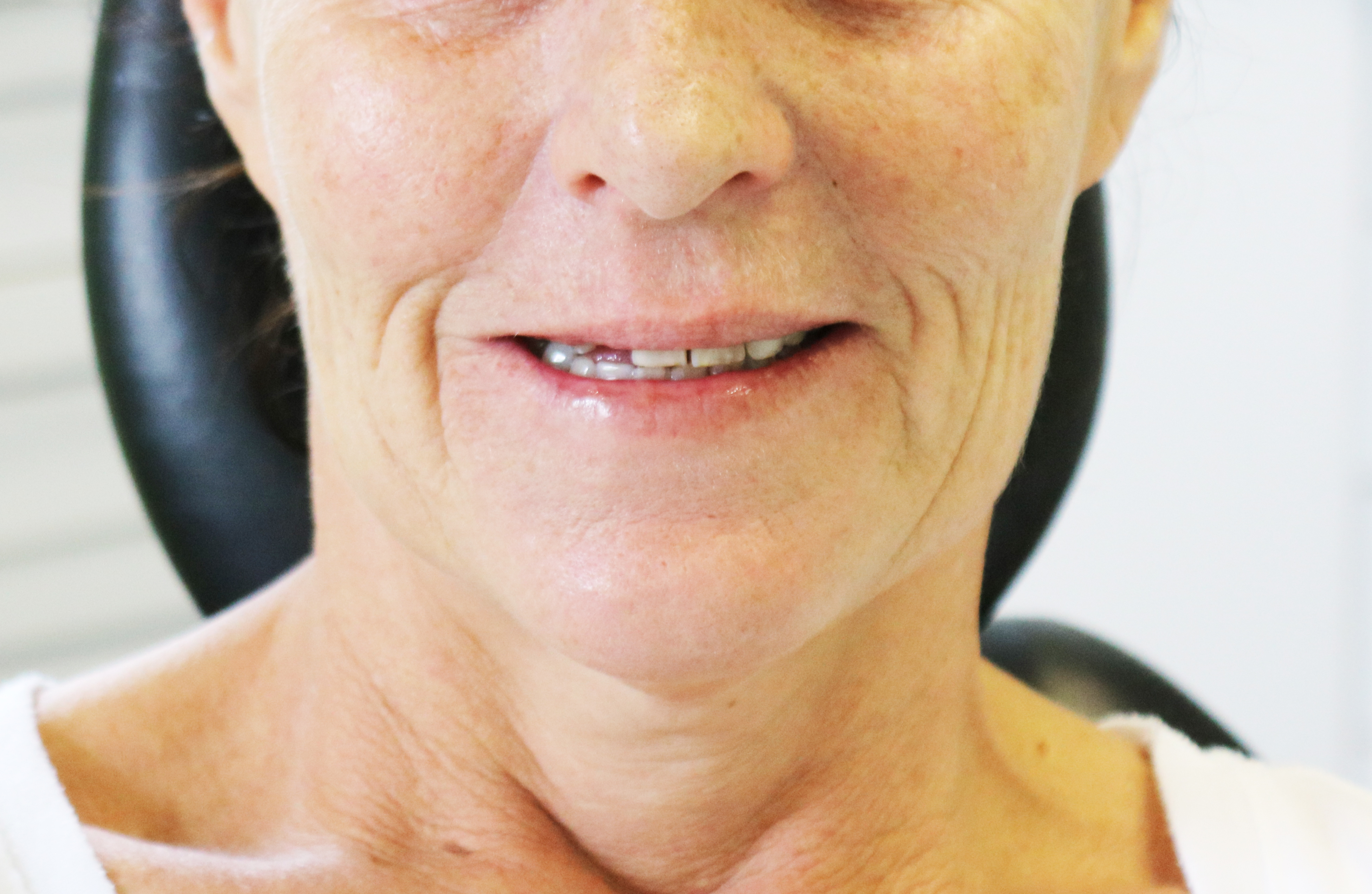 SMILE MAKEOVER BEFORE