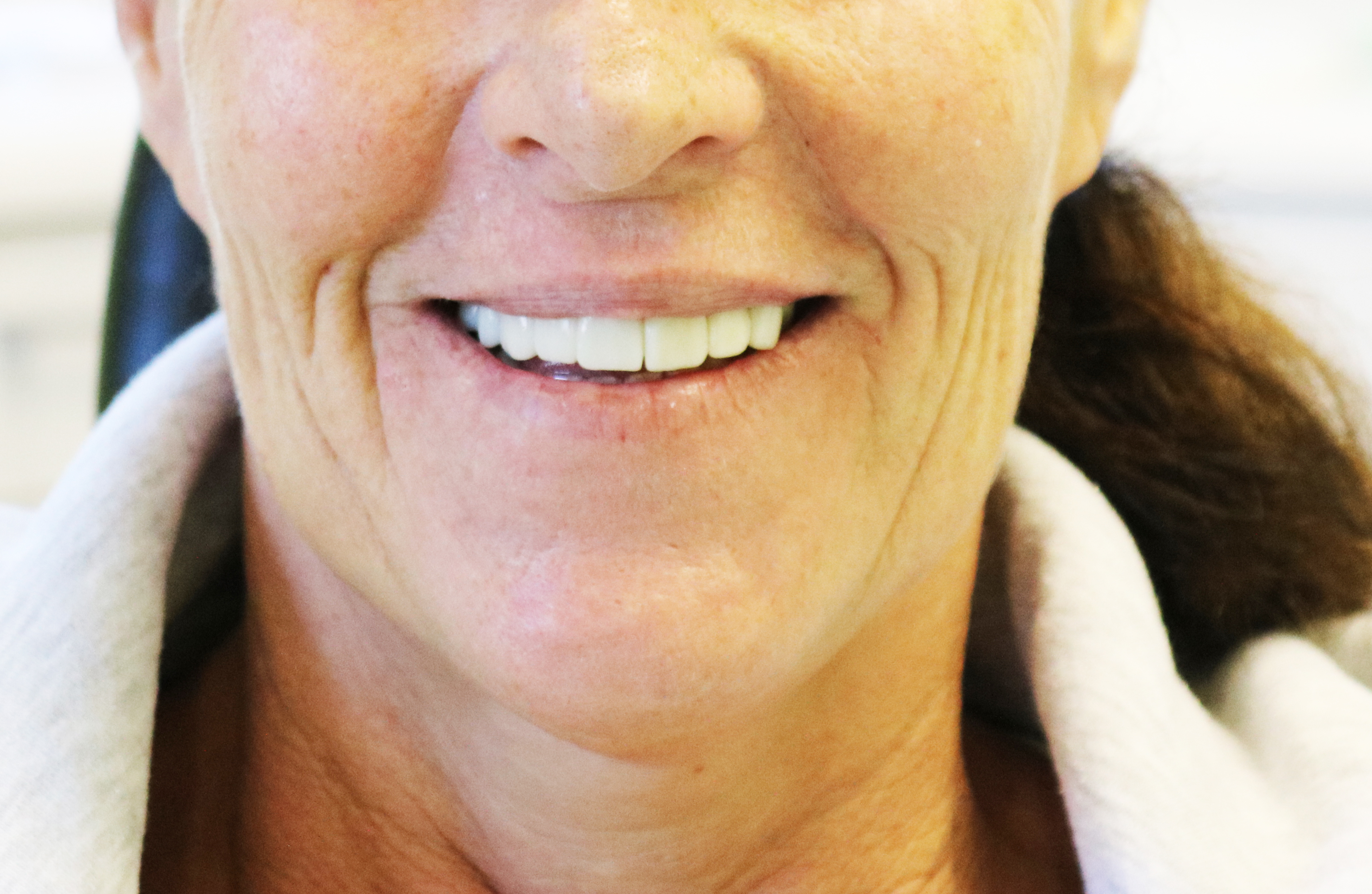 SMILE MAKEOVER AFTER
